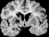 Arterial Border Zone Infarcts, unilateral